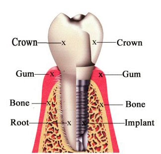 Dental Implant Side View